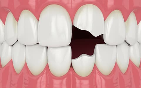 欠けた歯・折れた歯をそのままにしておくことは危険です