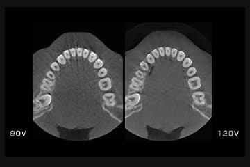 歯科用CT