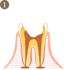 むし歯の進行度1