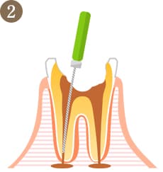 むし歯の進行度2