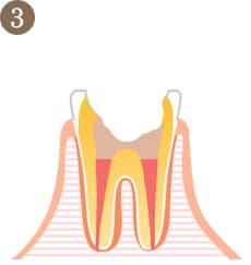 むし歯の進行度3