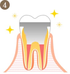 むし歯の進行度4