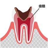 重度のむし歯