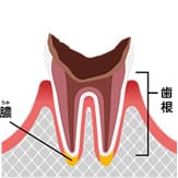 最重度のむし歯