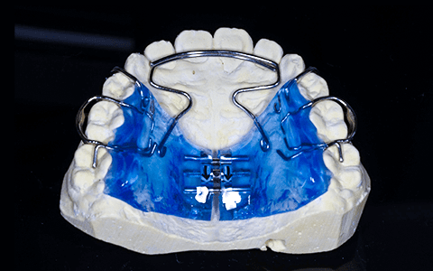 歯列拡大装置