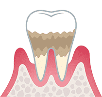 中軽度歯肉炎