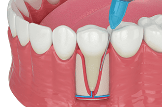 歯周再生療法