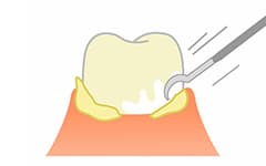 歯石やステインの除去