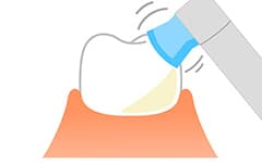 歯面の研磨