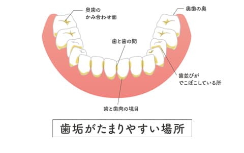 歯垢がたまりやすい場所